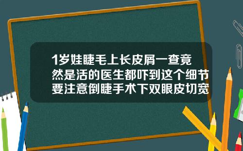 1岁娃睫毛上长皮屑一查竟然是活的医生都吓到这个细节要注意倒睫手术下双眼皮切宽了